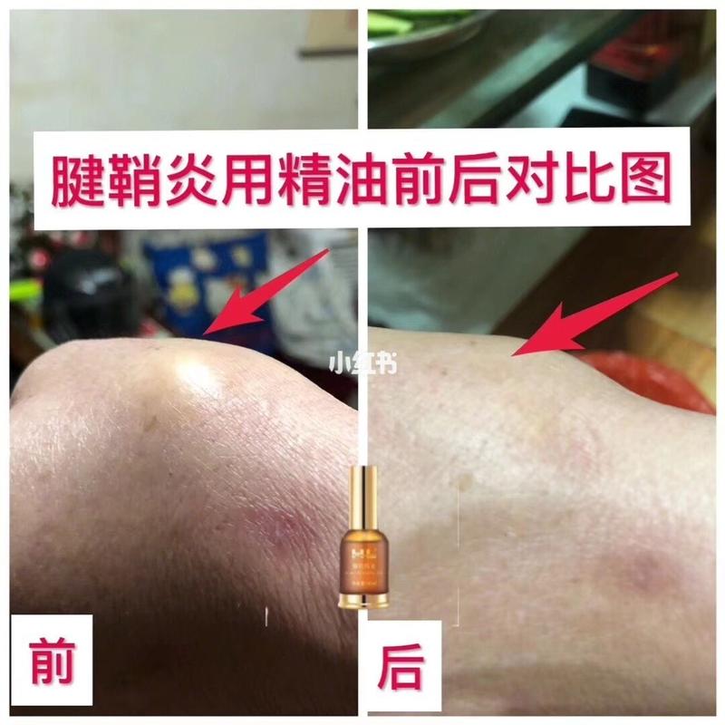 顧客腱鞘炎用精油前后對(duì)比圖 好產(chǎn)品用效果說(shuō)話